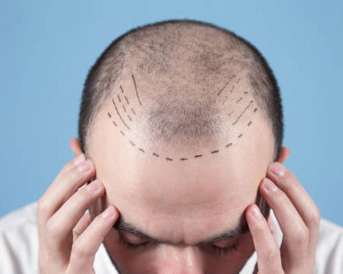 Hair Transplant